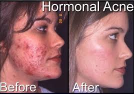 acne- hormonal