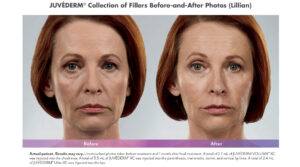 Juvederm Voluma 